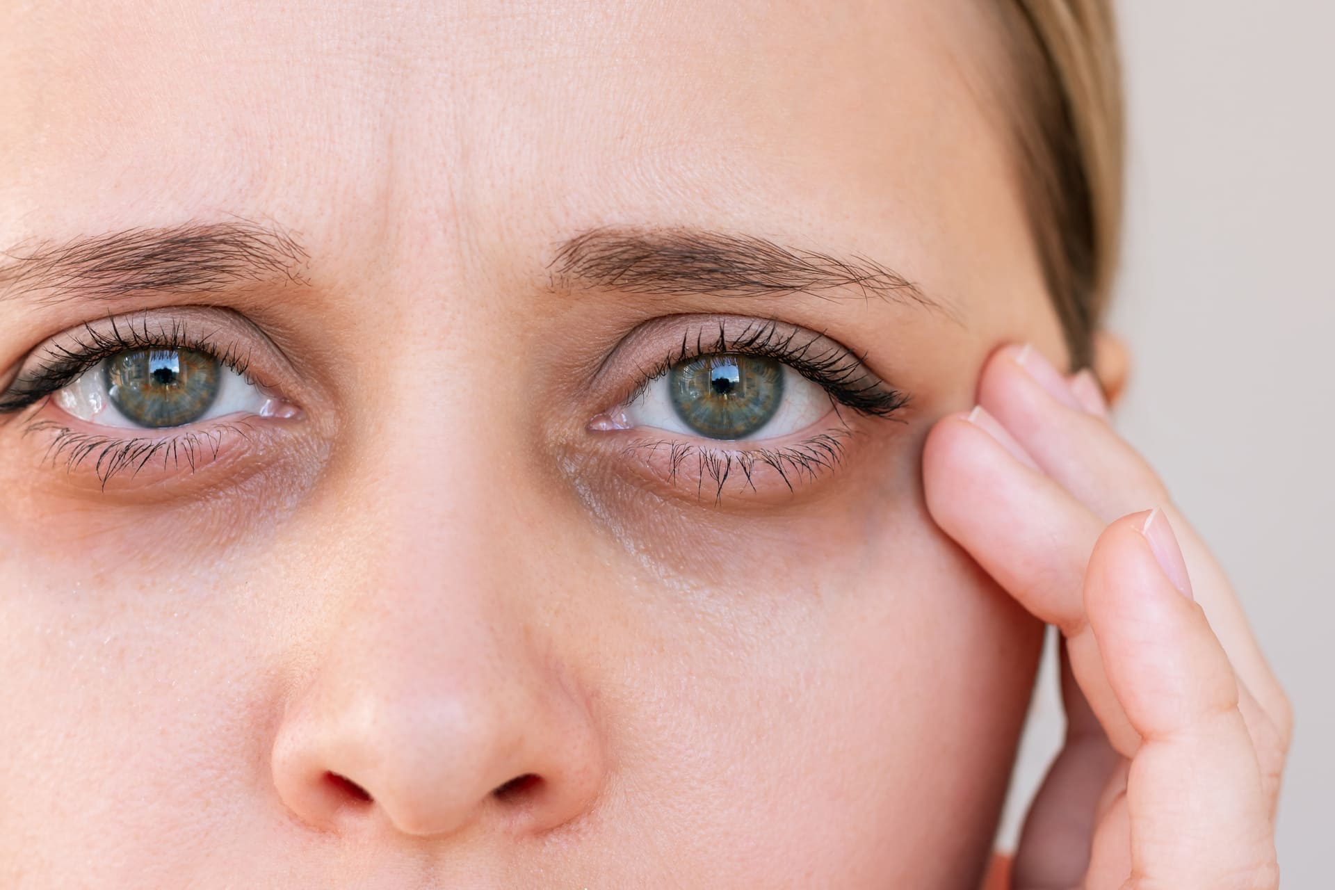 Augenringe entfernen: So wirst du dunkle Schatten sicher los